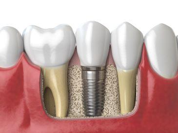Diagram of a dental implant, Lindenhurst NY