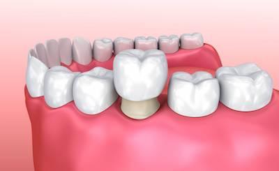Diagram of a tooth crown, lindenhurst ny