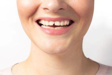 Woman with chipped tooth, Lindenhurst NY