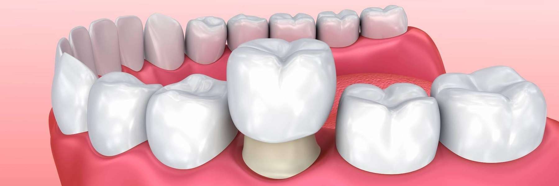 CEREC crown being placed on tooth model, lindenhurst ny
